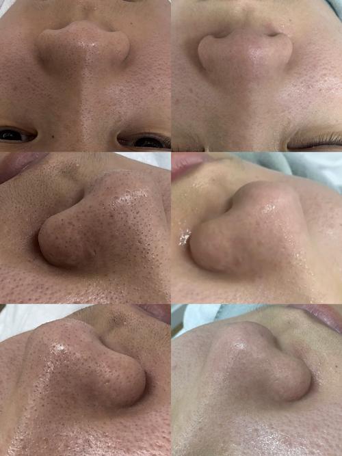 黑头是什么样子图片