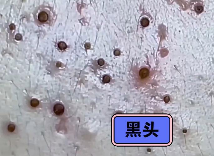 黑头是什么样子图片