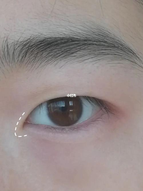 什么是内眦赘皮