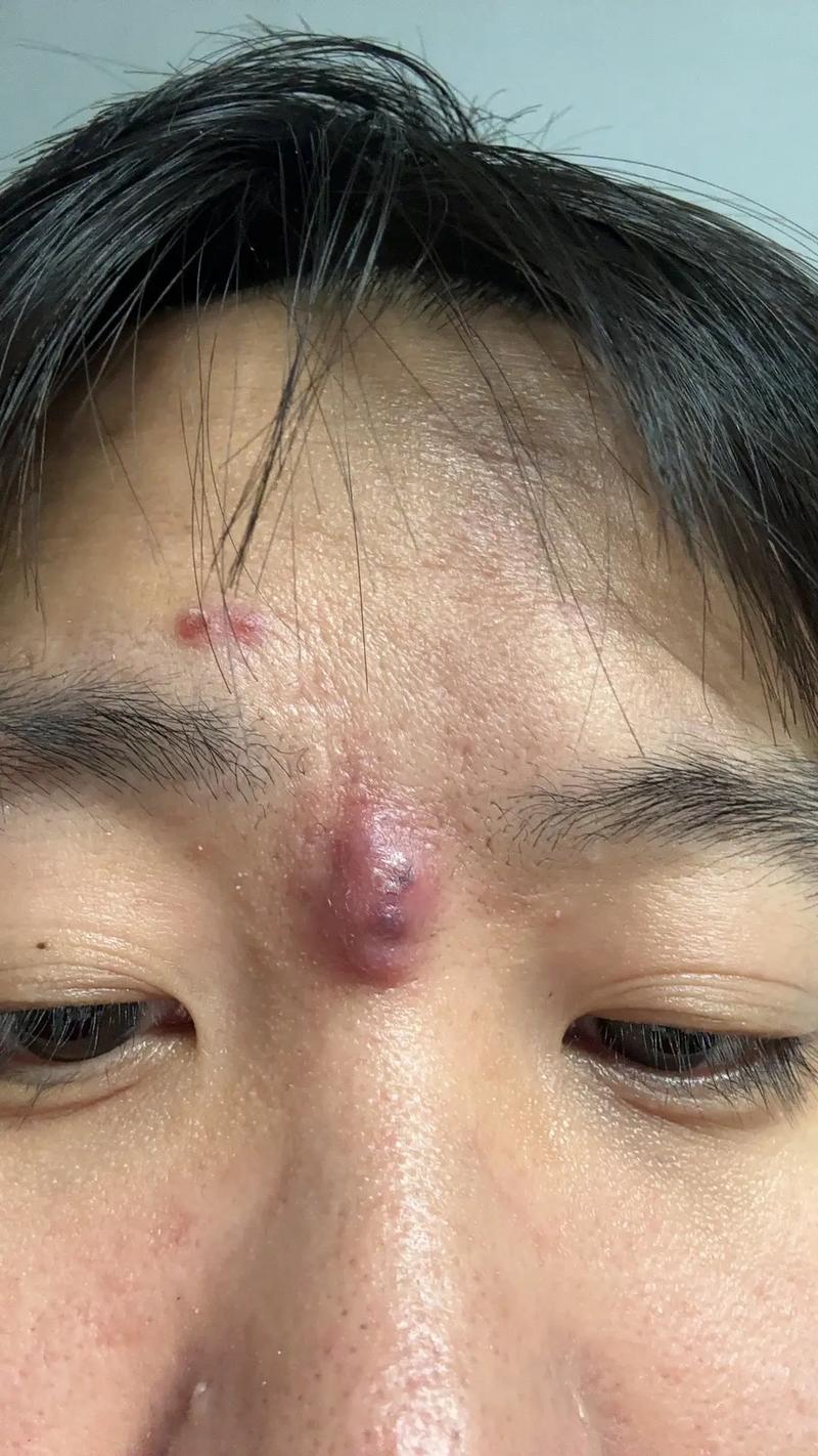 眉心长痘是为什么
