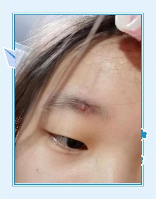 眉心长痘是为什么