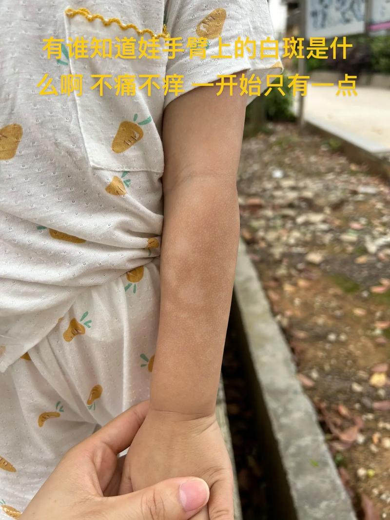 为什么手臂会长斑
