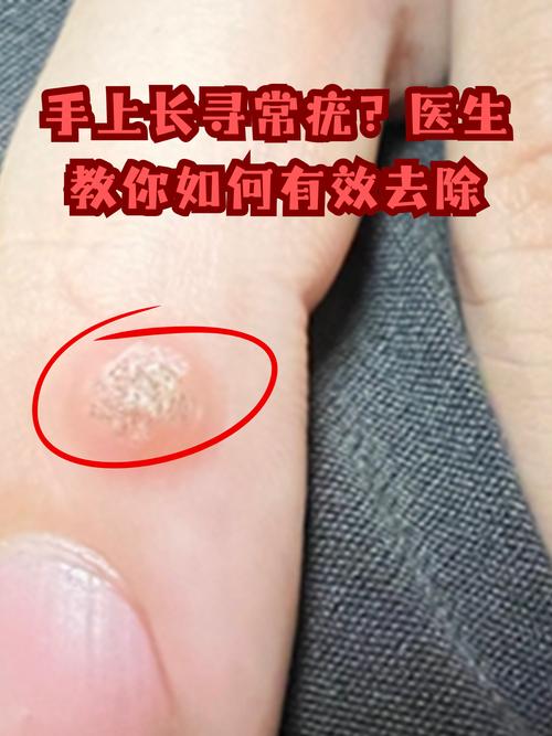 寻常疣是什么病毒