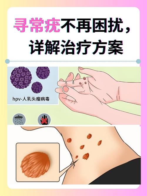 寻常疣是什么病毒