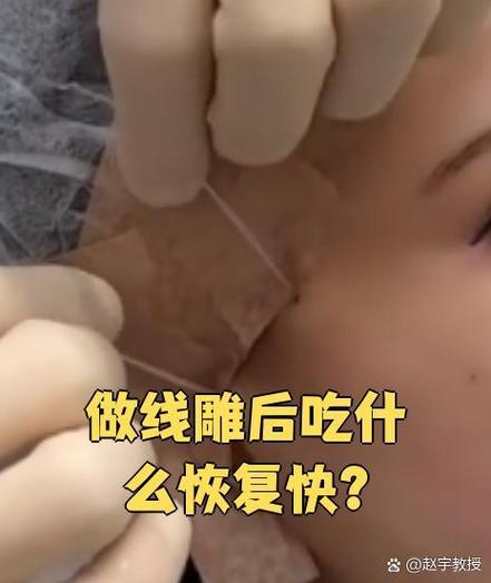 线雕后吃什么