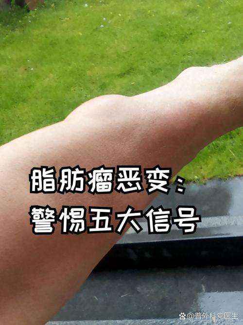 脂肪高有什么症状