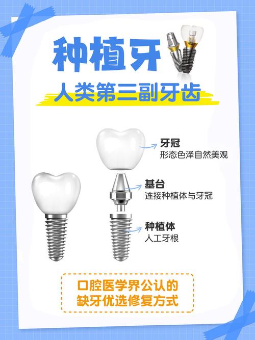 种植牙什么材料最好
