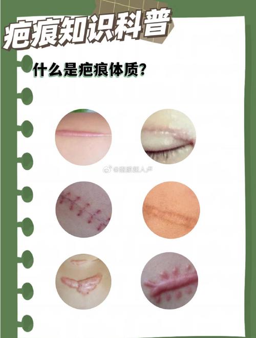 什么是疤痕体质图片