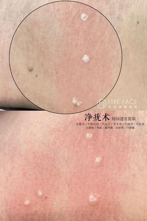 扁平尤是什么