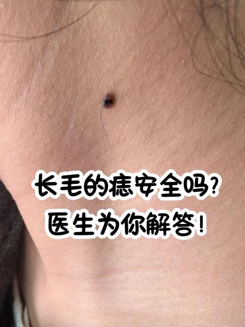 为什么痣毛