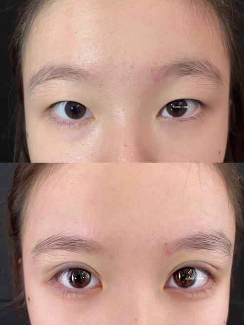 埋线双眼皮什么意思