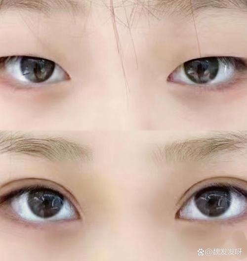 埋线双眼皮什么意思