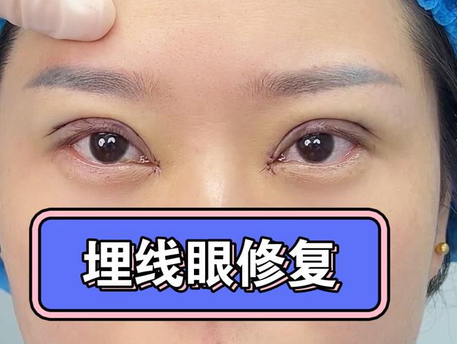 埋线双眼皮什么意思