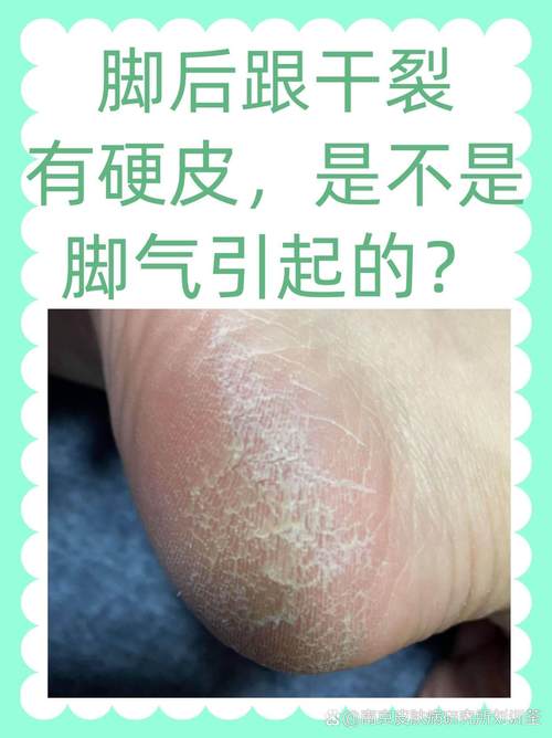 脚后跟起皮什么原因