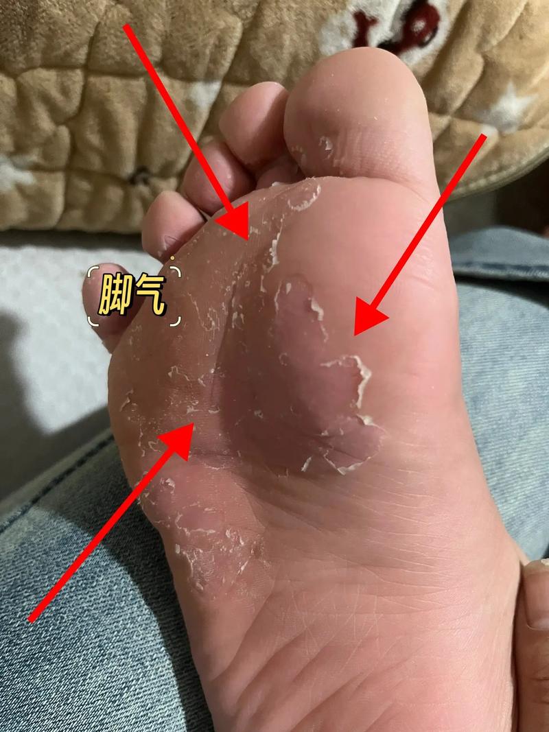 脚后跟起皮什么原因