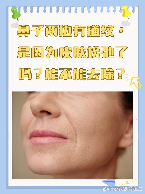 鼻子两边叫什么纹