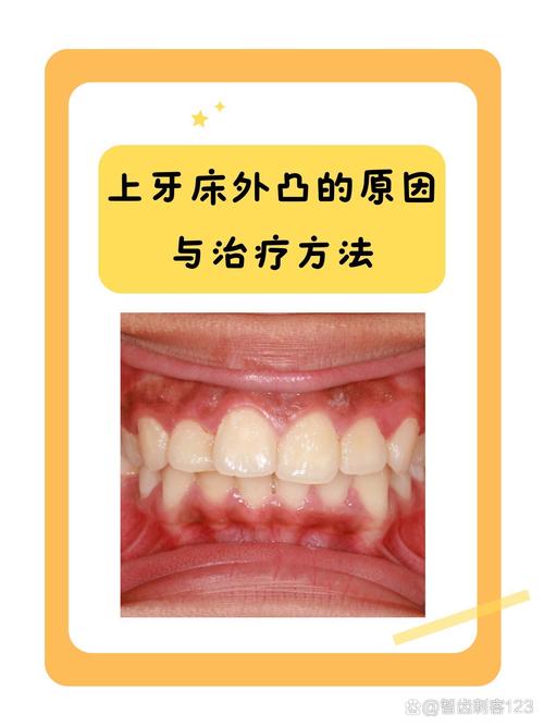 牙龈突出是什么原因