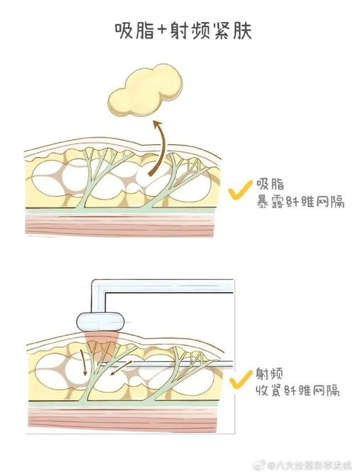 溶脂针是什么原理