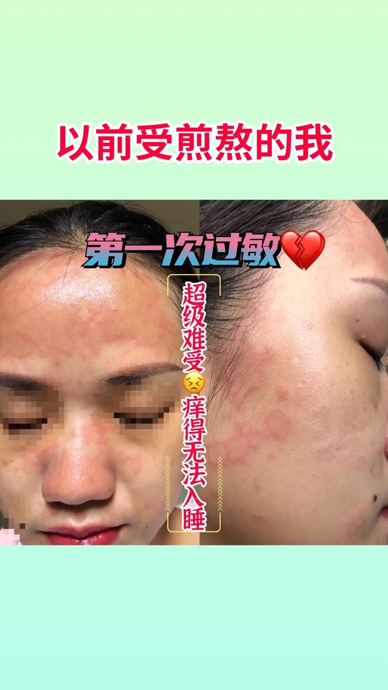 洗面奶过期了脸变红了怎么办