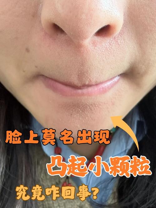 脸颊长粉刺什么原因