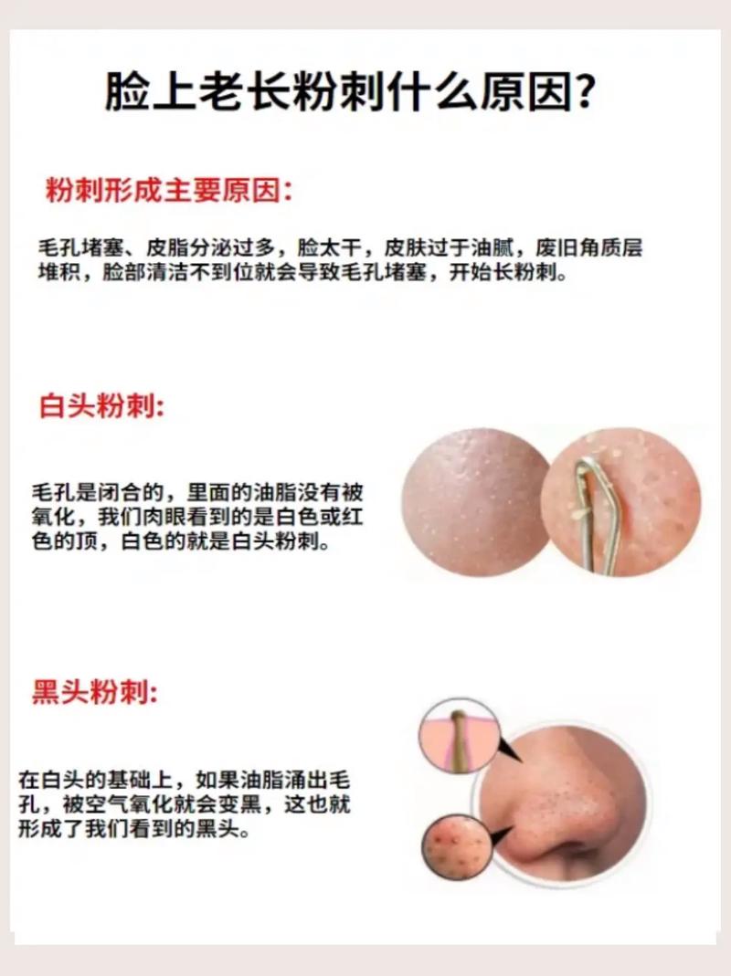 脸颊长粉刺什么原因