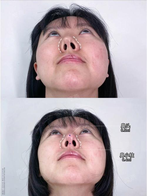 鼻子歪什么原因
