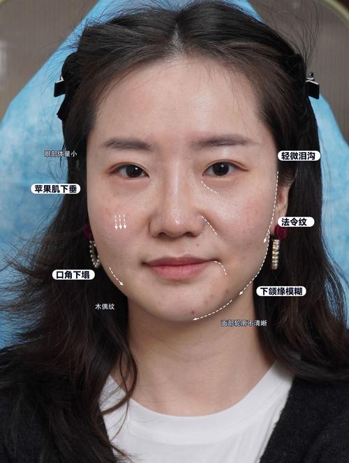 面部填充用什么最好