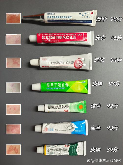 皮肤湿疹擦什么药膏