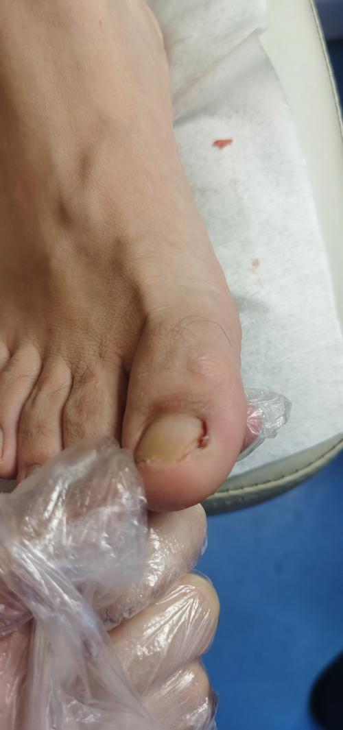 甲沟炎有什么危害