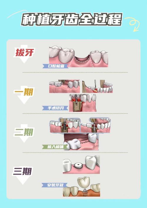 牙齿种植是什么