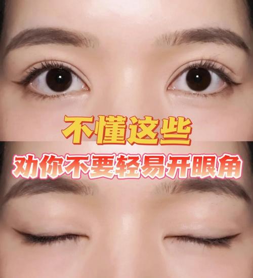 为什么开眼角