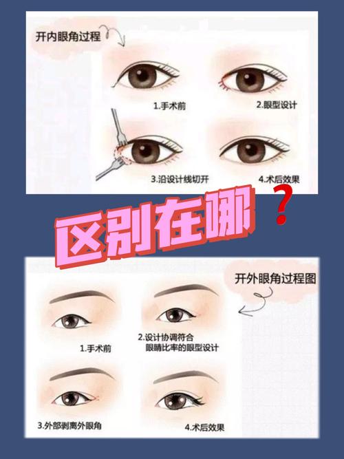 为什么开眼角