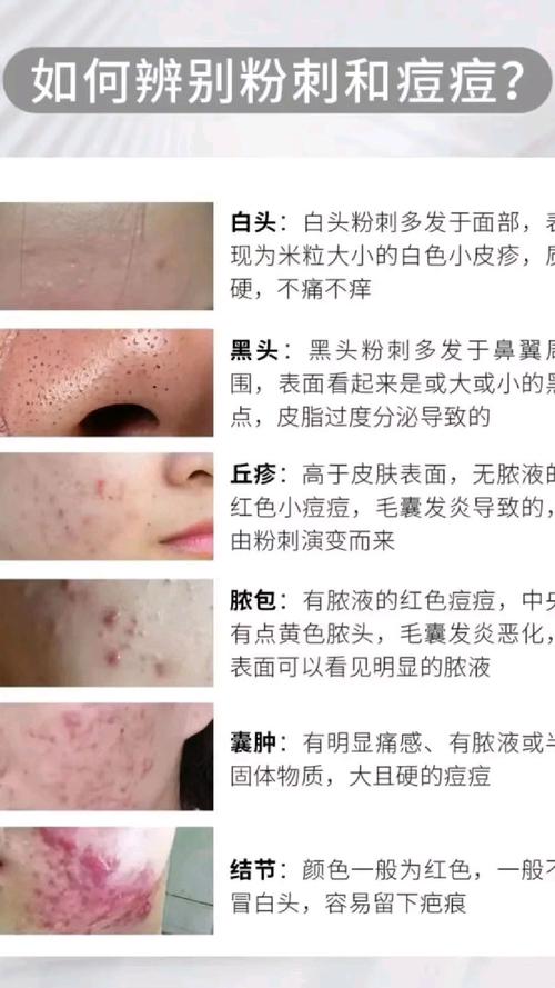 什么是痤疮痘痘