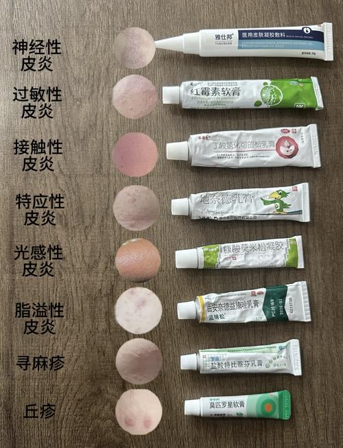 神经性皮炎擦什么药