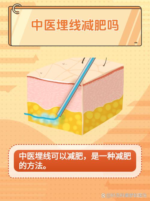 埋线减肥是埋的什么