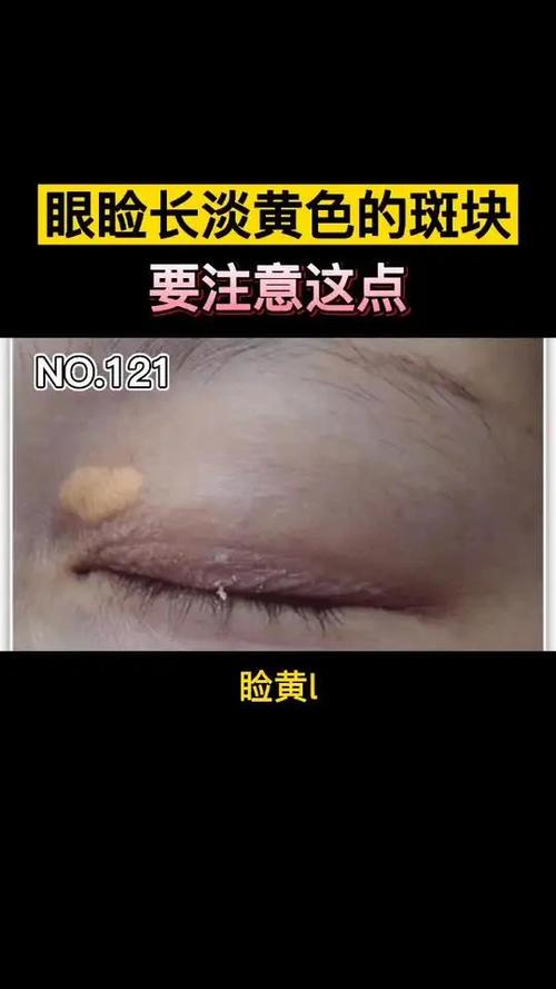 眼皮长斑是什么原因