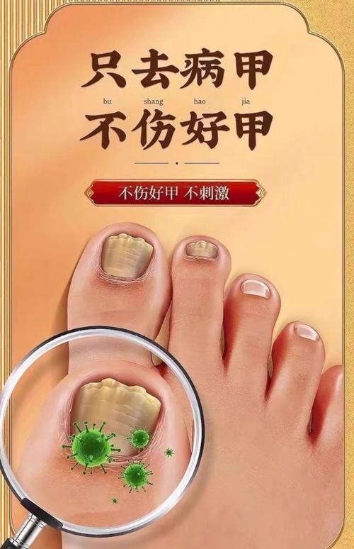 什么治灰指甲最有效