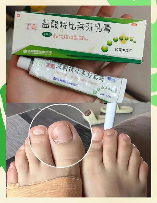 什么治灰指甲最有效
