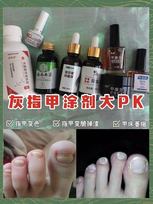 什么治灰指甲最有效