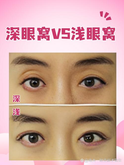 眼窝深是什么原因