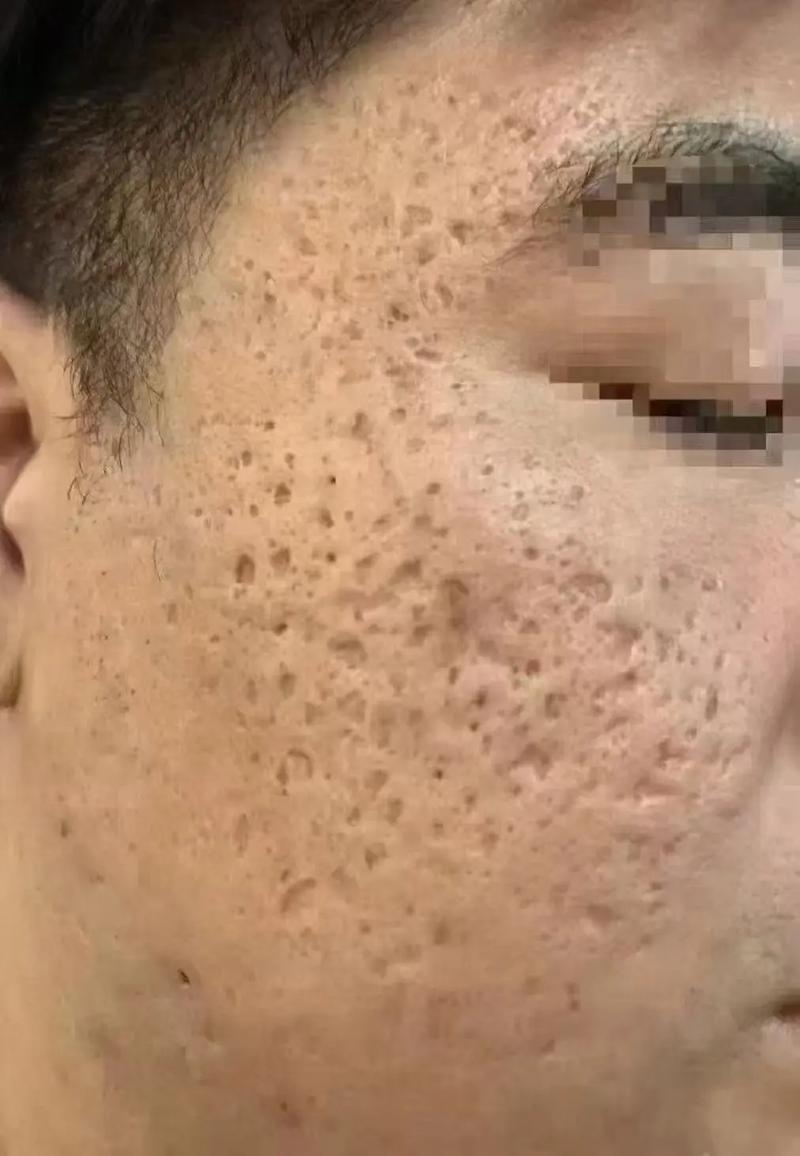 为什么脸上有小坑