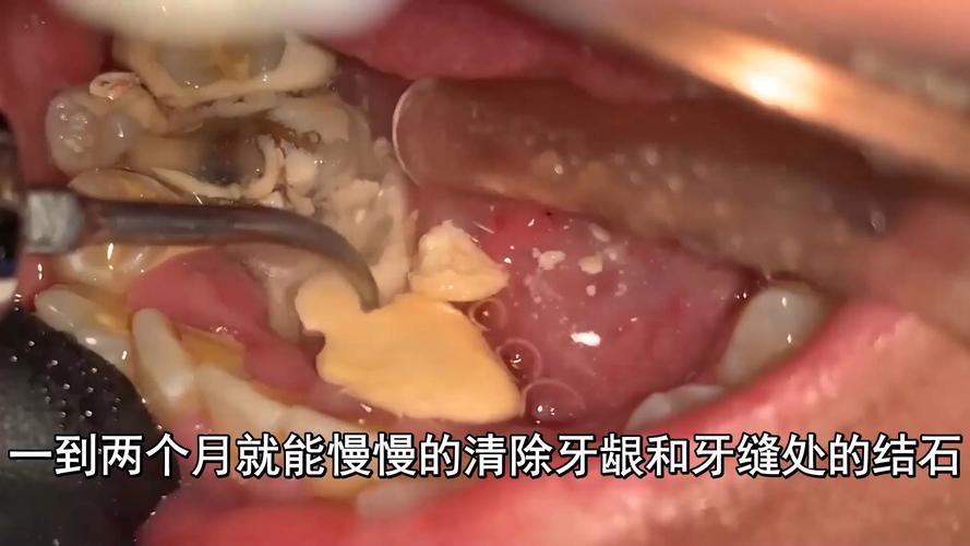 牙石长什么样
