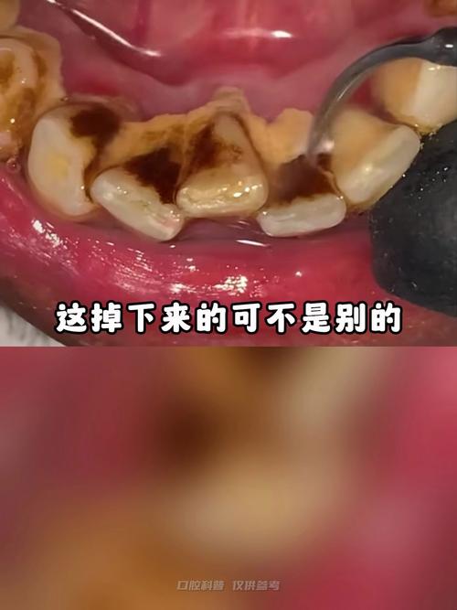 牙石长什么样