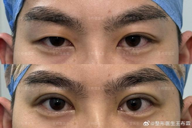 大小眼做什么手术