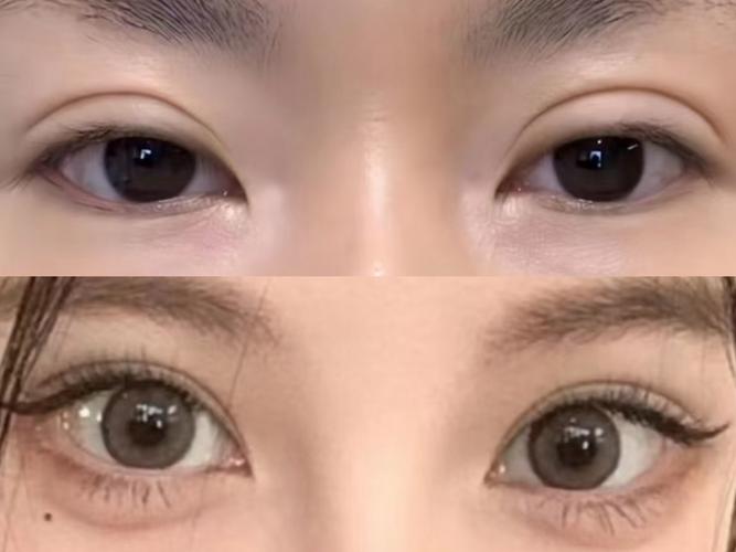 大小眼做什么手术