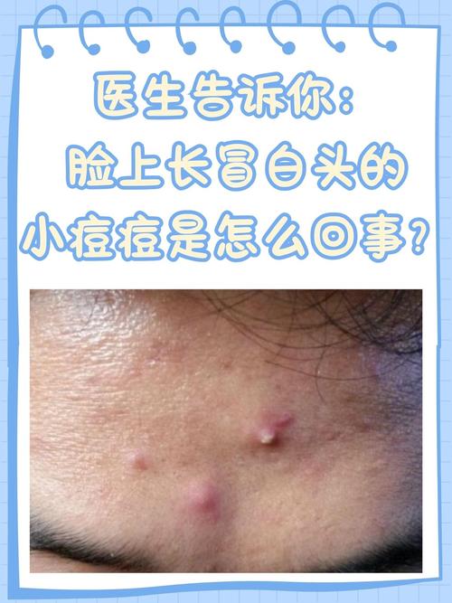 脸上为什么会有粉刺
