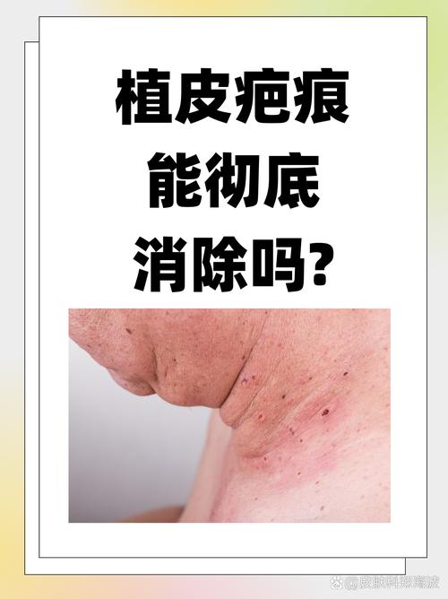 为什么植皮