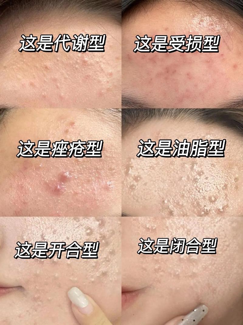 什么叫做闭口