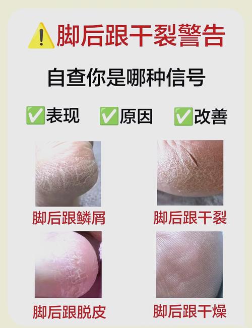 脚干脚裂是什么原因