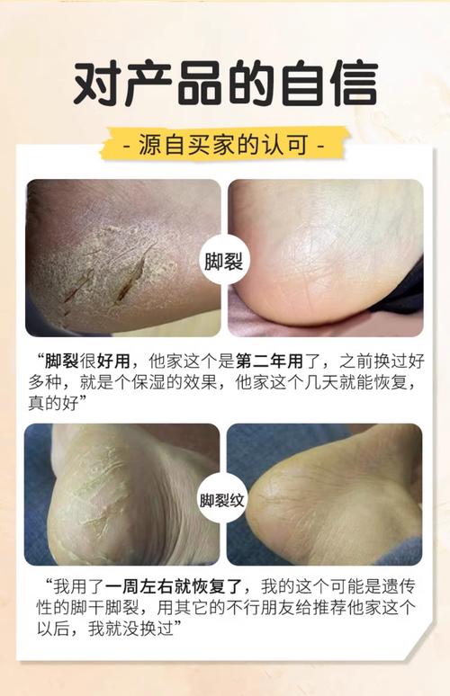 脚干脚裂是什么原因